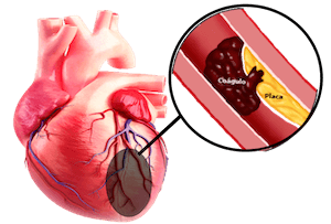 Dolor en el corazón